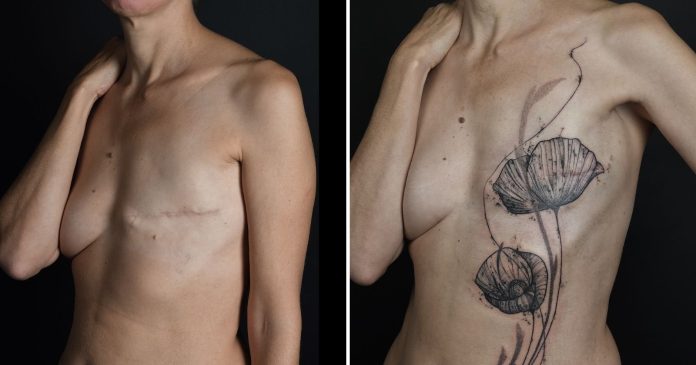 Breast cancer: what if tattooing had become a therapeutic tool in its own right?


